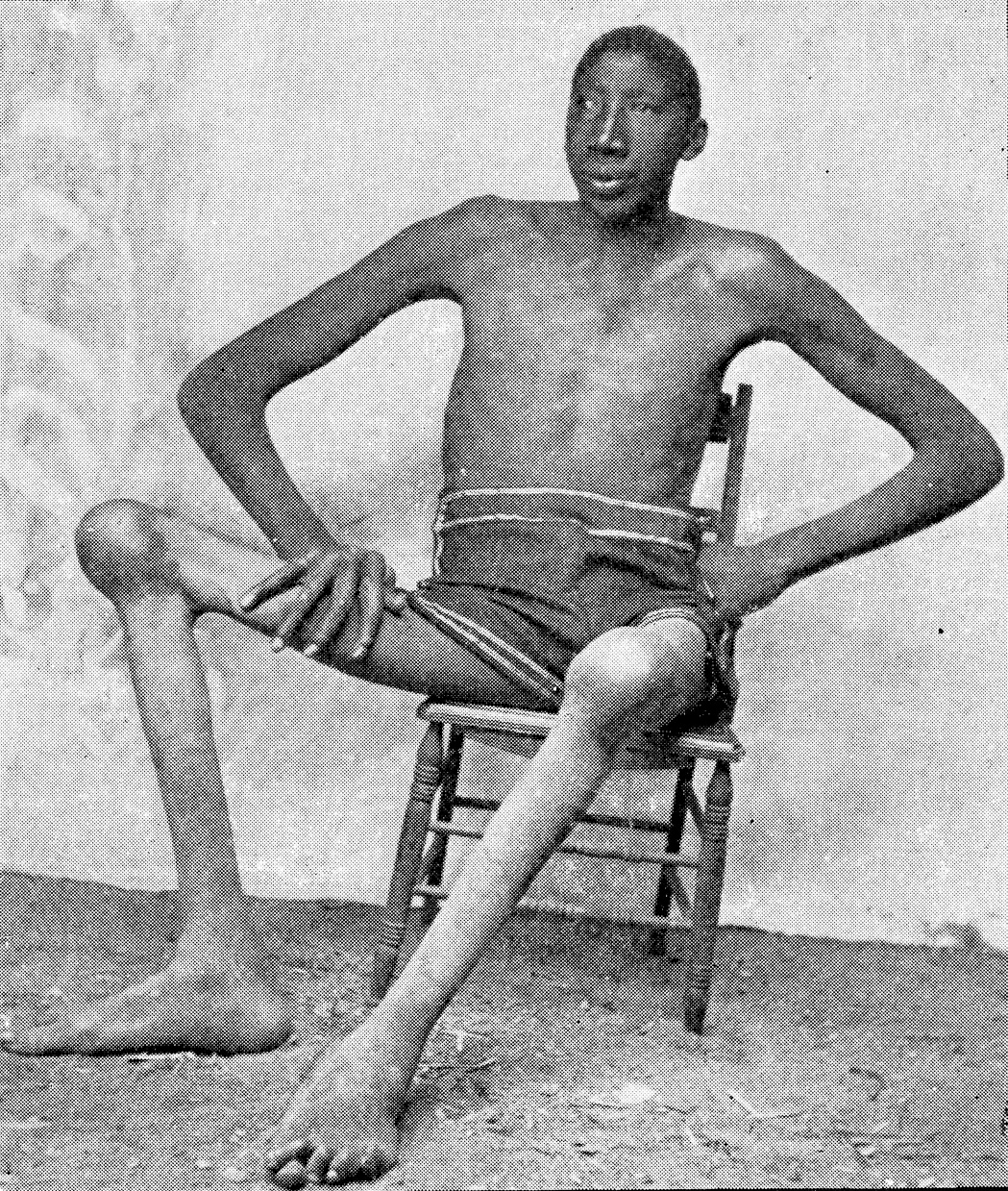 Acromegaly giantism gigantism