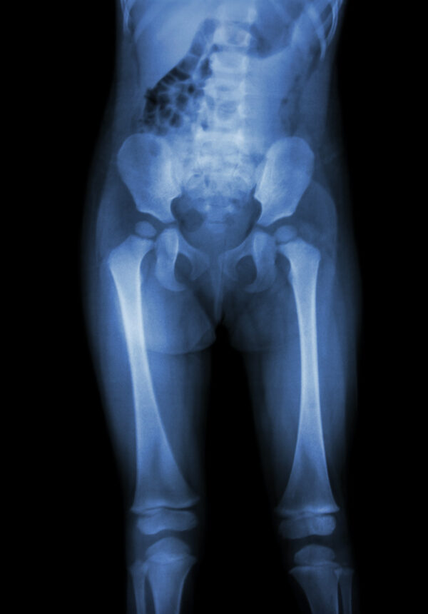 X-ray epiphyseal cartilage of bones